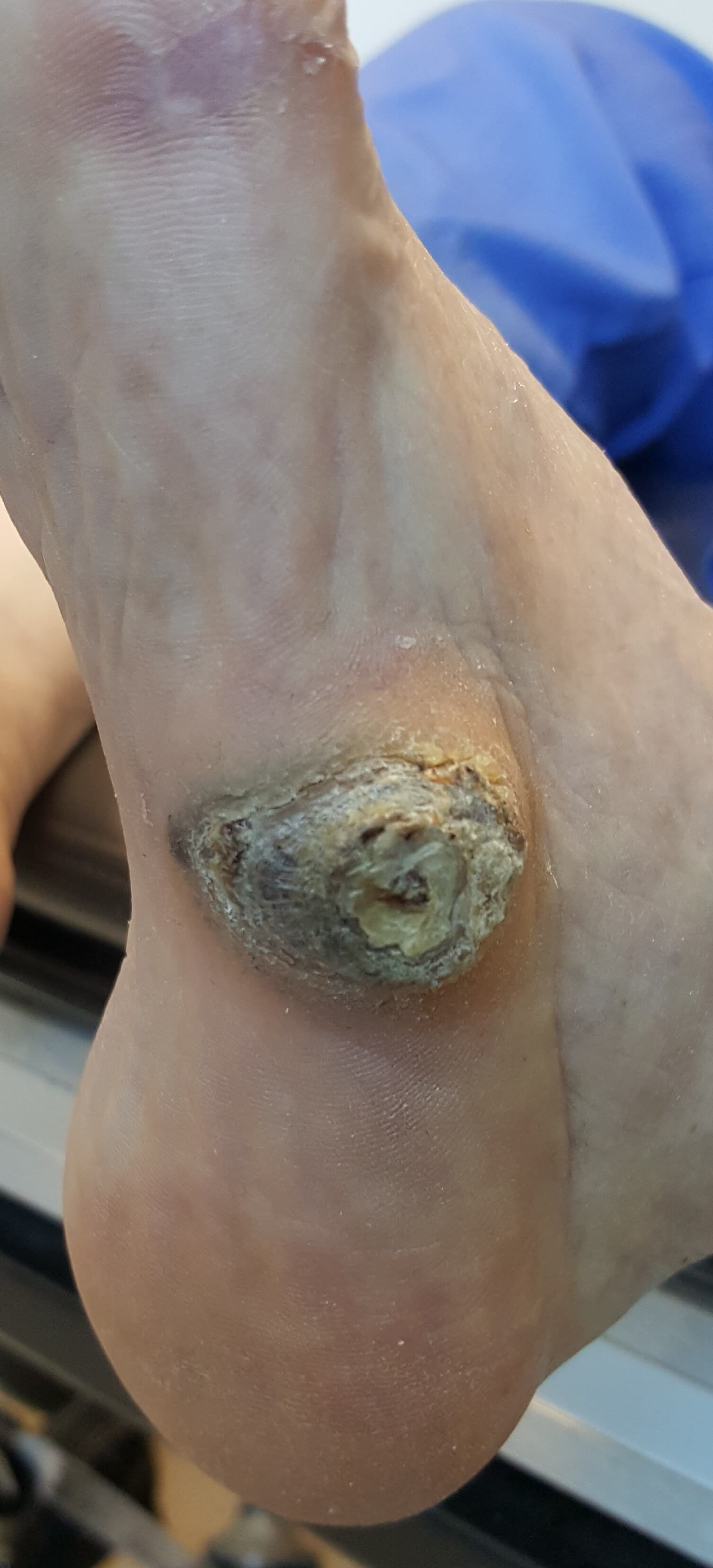Corns and Callus Treatment