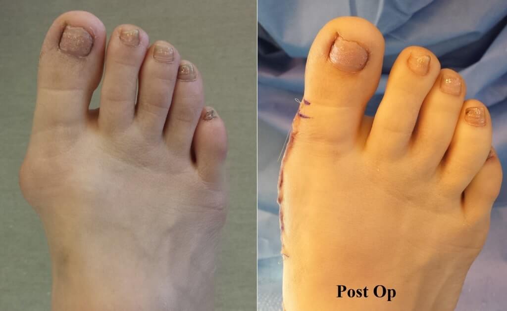 Bunion Surgery Orange County