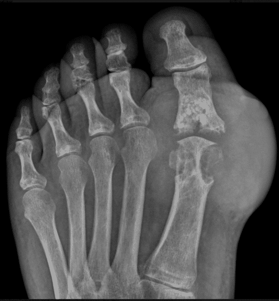 Gout OC Podiatry