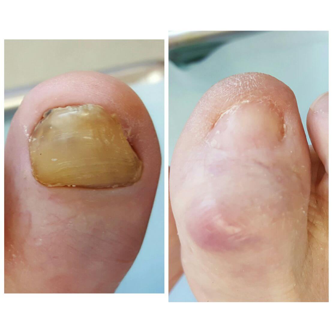 Ingrown ToeNail Orange County
