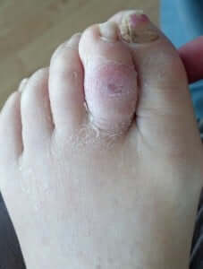 Closed Toe Ulcer South County California Orange County, Mission Viejo, Aliso Viejo, Lake Forest, Laguna Hills, Laguna Beach, Irvine, Newport Beach, Tustin, Orange, Anaheim, Fullerton, Santa Ana, Laguna Niguel, Dana Point.