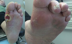 Closed foot diabetic ulcer after a simple surgery Laguna Hills orange county Orange County, Mission Viejo, Aliso Viejo, Lake Forest, Laguna Hills, Laguna Beach, Irvine, Newport Beach, Tustin, Orange, Anaheim, Fullerton, Santa Ana, Laguna Niguel, Dana Point.