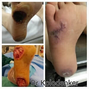 Healed Diabetic Heel Ulcer/Wound after surgery in Orange County with the help of Wound VAC