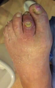 Open Toe Ulcer San Clemente Southern California Orange County, Mission Viejo, Aliso Viejo, Lake Forest, Laguna Hills, Laguna Beach, Irvine, Newport Beach, Tustin, Orange, Anaheim, Fullerton, Santa Ana, Laguna Niguel, Dana Point.