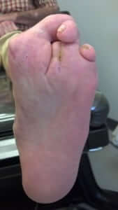 Healed Diabetic foot Ulcer Closed Orange County, Mission Viejo, Aliso Viejo, Lake Forest, Laguna Hills, Laguna Beach, Irvine, Newport Beach, Tustin, Orange, Anaheim, Fullerton, Santa Ana, Laguna Niguel, Dana Point.