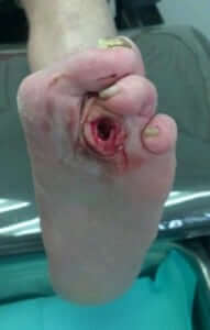 Diabetic Foot Ulceration in Orange County, Mission Viejo, Aliso Viejo, Lake Forest, Laguna Hills, Laguna Beach, Irvine, Newport Beach, Tustin, Orange, Anaheim, Fullerton, Santa Ana, Laguna Niguel, Dana Point.