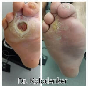 Diabetic Foot Wound/Ulcer healed Orange County Irvine Prevent amputation Orange County, Mission Viejo, Aliso Viejo, Lake Forest, Laguna Hills, Laguna Beach, Irvine, Newport Beach, Tustin, Orange, Anaheim, Fullerton, Santa Ana, Laguna Niguel, Dana Point. 