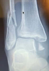 Ankle Fracture Surgeon Orange County Irvine HB Orange