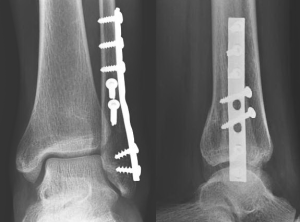 Ankle Fracture Open Reduction with Internal Fixation Southern California - Irvine HB Orange