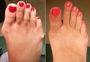 Bunion surgery pictures orange county 