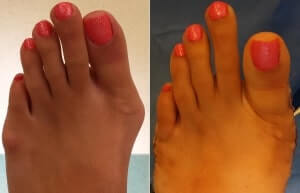 Bunion Pictures Before and After Surgery Orange County, bunion surgery orange county