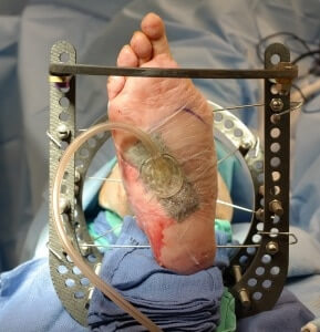 charcot foot and ankle reconstruction orange county external fixator