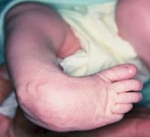 Clubfoot surgeon in orange county southern california