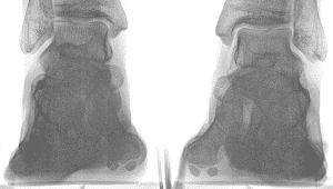 Fracture of Sesamoid Mission Viejo, Aliso Viejo, Lake Forest, Laguna Hills, Laguna Beach, Irvine, Newport Beach, Tustin, Orange, Anaheim, Fullerton, Santa Ana, Laguna Niguel, Dana Point.