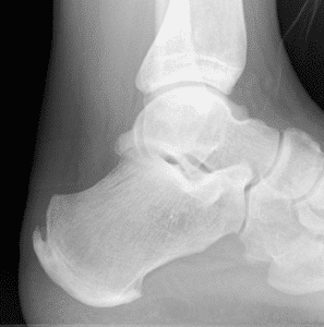 Haglunds Deformity on X-Ray "pump bump"