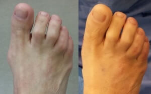 Minimally Invasive Bunion Surgery Pictures Before and After Operation Orange County Bunion