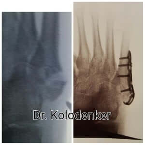 fifth metatarsal fracture orange county