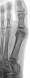 Sesamoid fracture Mission Viejo, Aliso Viejo, Lake Forest, Laguna Hills, Laguna Beach, Irvine, Newport Beach, Tustin, Orange, Anaheim, Fullerton, Santa Ana, Laguna Niguel, Dana Point.