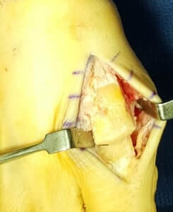 big toe joint pain after surgery cheilectomy orange county