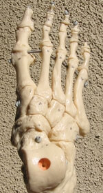 Puncture Wound in the Foot Toes Orange County Mission Viejo, Aliso Viejo, Lake Forest, Laguna Hills, Laguna Beach, Irvine, Newport Beach, Tustin, Orange, Anaheim, Fullerton, Santa Ana, Laguna Niguel, Dana Point.