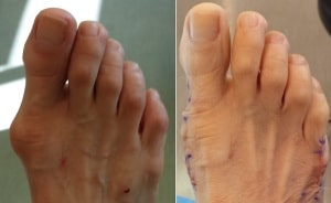 bunion surgeon in newport beach california before and after pictures bunion surgery orange county 