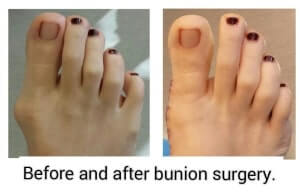 bunion surgery before and after picture - bunion expert in orange county - irvine - newport - mission viejo