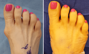 bunion surgery pictures before and after Southern California Bunion Irvine