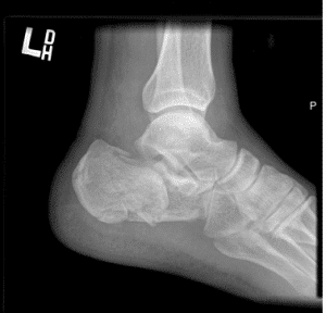 Calcaneus fracture surgeon in orange county irvine huntington beach minimally invasive surgery