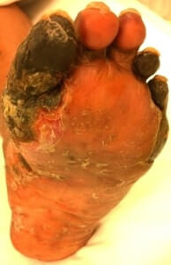 Skin graft surgeon foot ankle Orange County, Mission Viejo, Aliso Viejo, Lake Forest, Laguna Hills, Laguna Beach, Irvine, Newport Beach, Tustin, Orange, Anaheim, Fullerton, Santa Ana, Laguna Niguel, Dana Point.