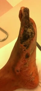 Skin graft surgeon foot ankle Orange County, Mission Viejo, Aliso Viejo, Lake Forest, Laguna Hills, Laguna Beach, Irvine, Newport Beach, Tustin, Orange, Anaheim, Fullerton, Santa Ana, Laguna Niguel, Dana Point.