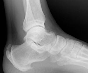 Posterior heel pain, achilles tendonosis, haglund