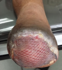 Skin graft surgeon foot ankle Orange County, Mission Viejo, Aliso Viejo, Lake Forest, Laguna Hills, Laguna Beach, Irvine, Newport Beach, Tustin, Orange, Anaheim, Fullerton, Santa Ana, Laguna Niguel, Dana Point.