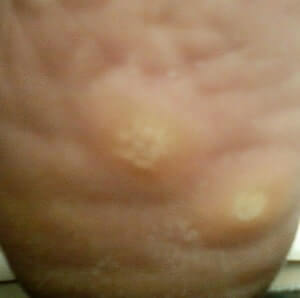 Plantar Wart Pictures