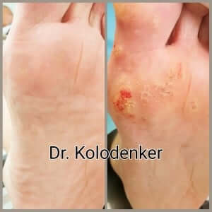 Plantar wart Orange County, Mission Viejo, Aliso Viejo, Lake Forest, Laguna Hills, Laguna Beach, Irvine, Newport Beach, Tustin, Orange, Anaheim, Fullerton, Santa Ana, Laguna Niguel, Dana Point. 