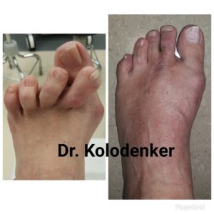 Best Bunion Surgeon