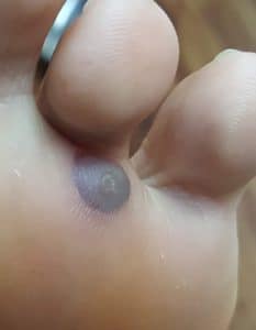 freezing wart treatment foot