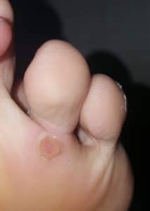 healed wart from freezing