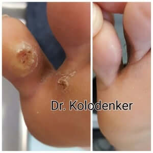 plantar wart orange county treatment cure Orange County, Mission Viejo, Aliso Viejo, Lake Forest, Laguna Hills, Laguna Beach, Irvine, Newport Beach, Tustin, Orange, Anaheim, Fullerton, Santa Ana, Laguna Niguel, Dana Point. 