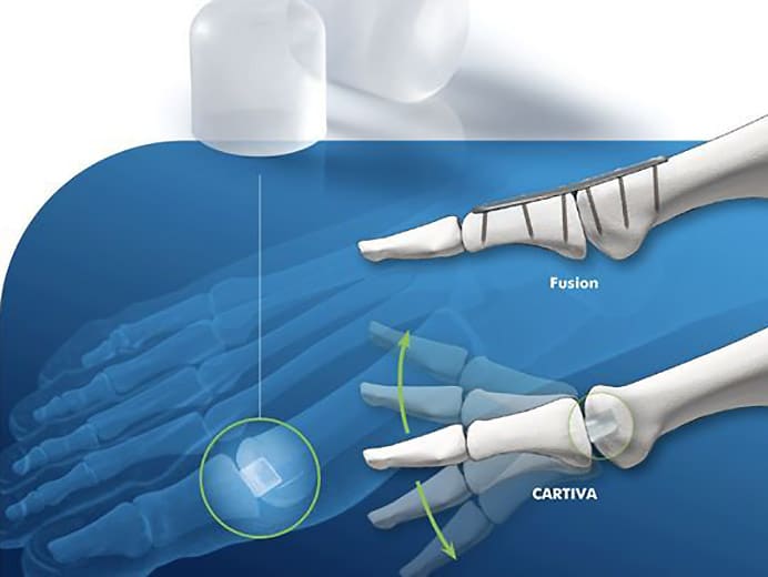 Cartiva Joint Replacement Orange County Irvine HB Orange